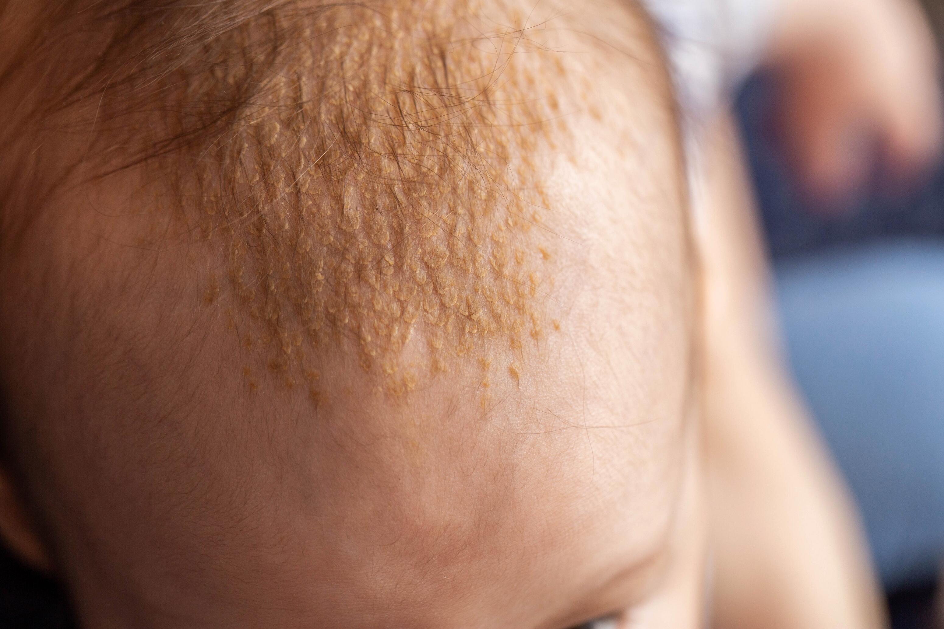 Dermatitis seborreica